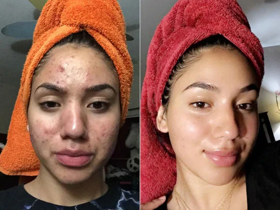 Eloria Rice Peel Serum Ampoule™ - Image 4
